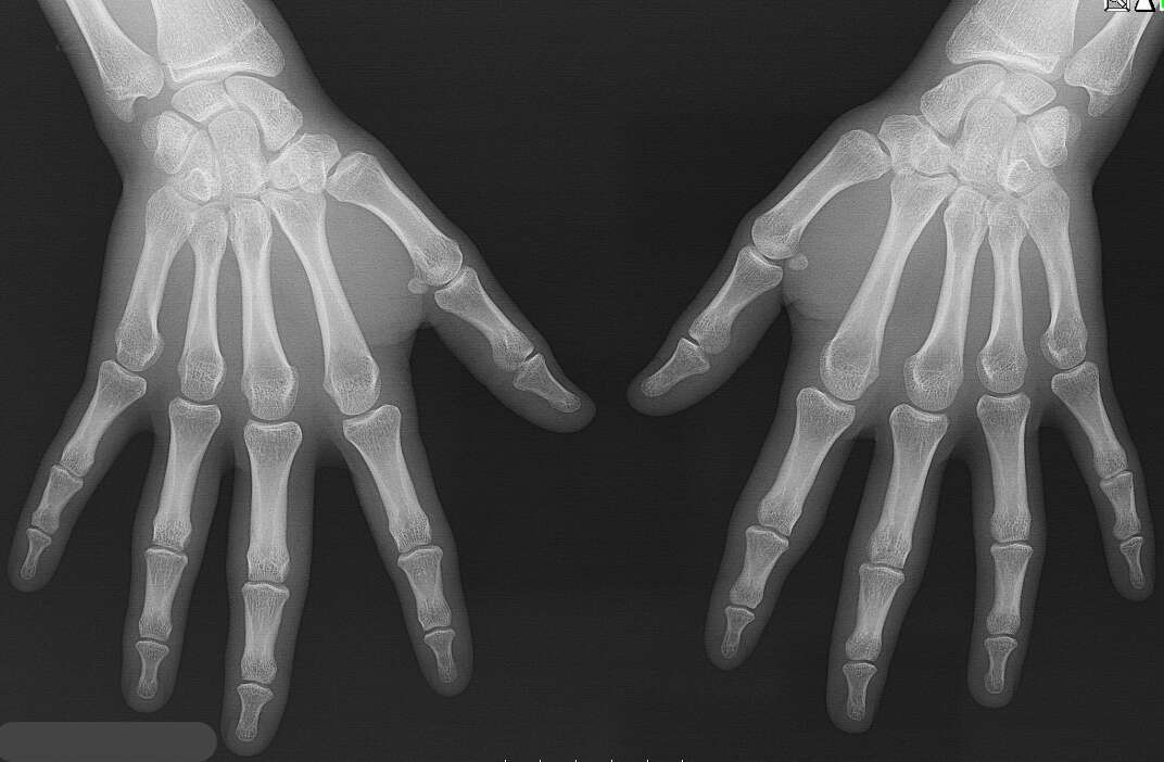 Hand radiograph showing soft-tissue enlargement of the PIP joints, without irregularities of the phalangeal epiphyses.